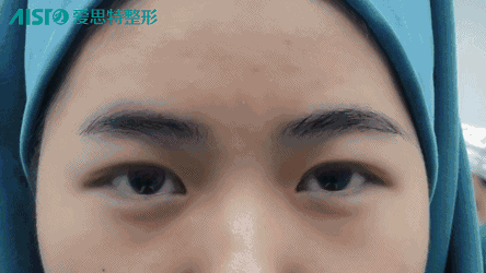 【美眼案例】你一定不知道刚割完的双眼皮是这样!
